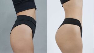 Việt kiều cấy mỡ mông ở Việt Nam giá bao nhiêu? Bao lâu được bay?