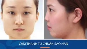 Cằm thanh tú chuẩn sao Hàn nhờ phẫu thuật Gọt Cằm V-line