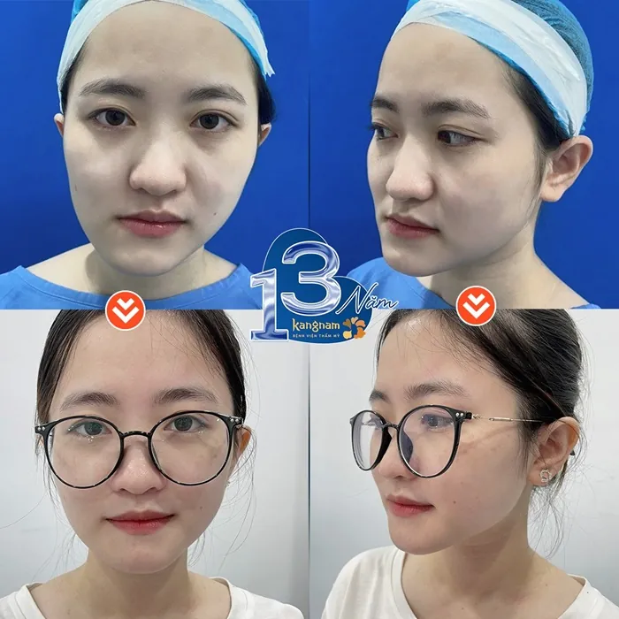 Kỹ thuật tạo cằm chẻ đơn giản, không nguy hiểm