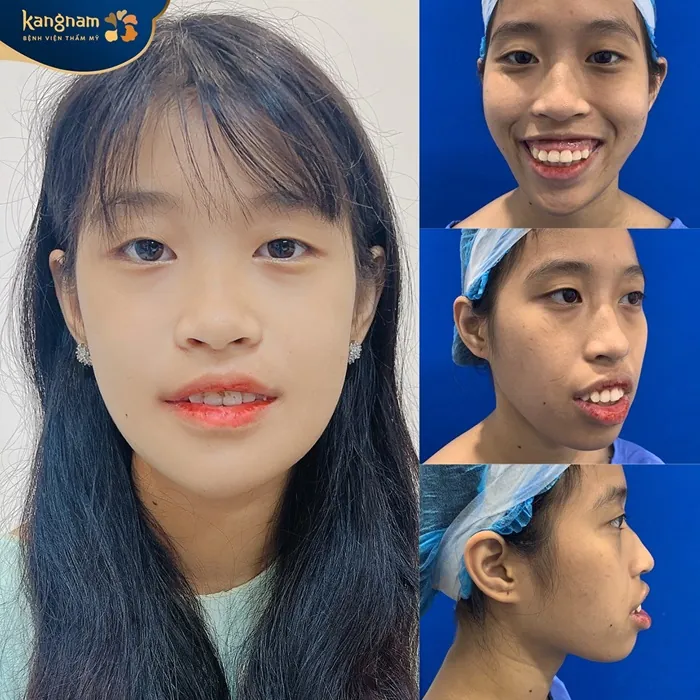 Hàm thay đổi sau khi khách hàng phẫu thuật tạo cằm tại Kangnam