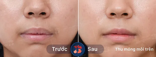 Khách hàng thu mỏng môi trên tại Kangnam