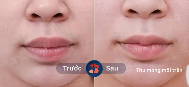 Kết quả trước và sau khi thu mỏng môi