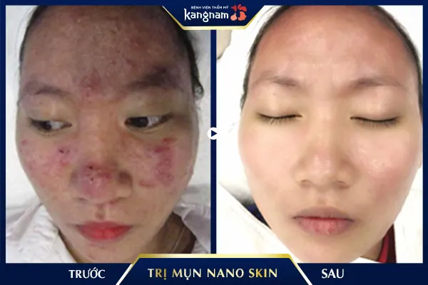 Mụn viêm có mủ cấp độ nặng quanh mặt chỉ sau 1 liệu trình được khắc phục hoàn toàn 