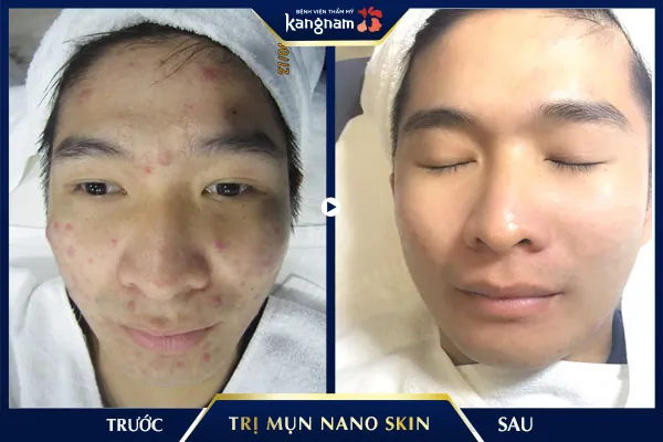 Kiểm chứng kế t quả khách hàng sau trị mụn tại BVTM Kangnam