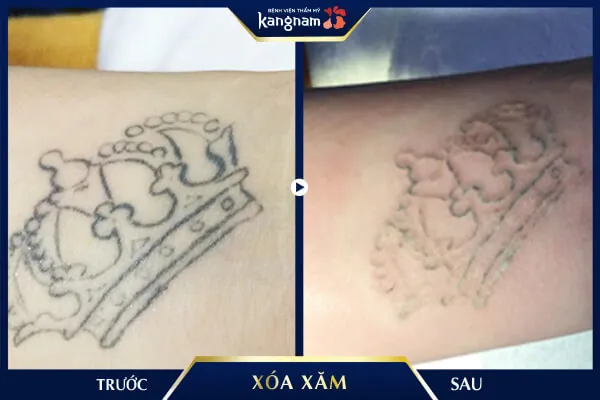 xóa xăm Laser Picosure