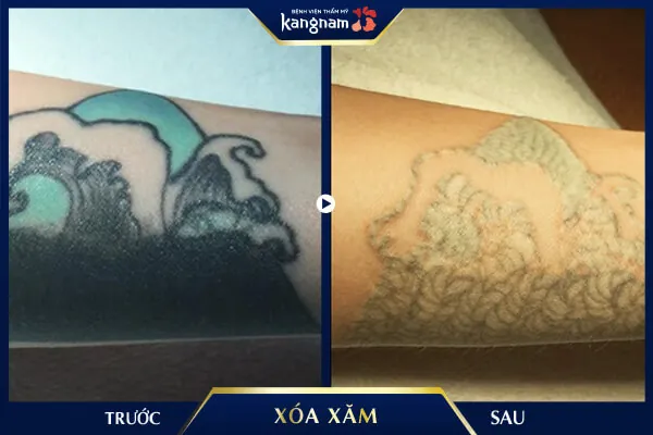Xóa xăm Laser Picosure