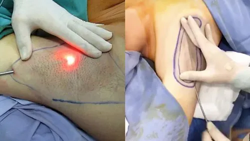 hút nội soi trị hôi nách