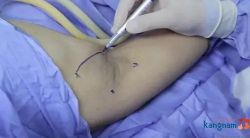 trị hôi nách bằng nội soi