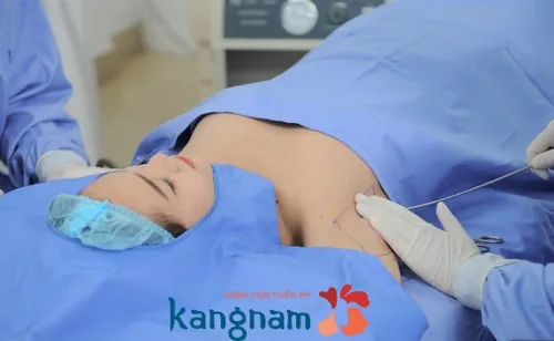 Trị hôi nách bằng công nghệ Endo Dry giúp nhanh chóng loại bỏ mùi hôi ra bên ngoài