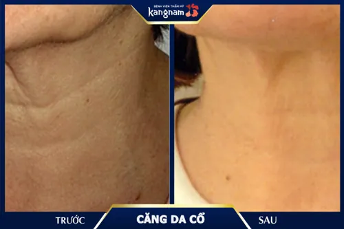 Hình ảnh căng da vùng cổ cho khách hàng có dấu hiệu chùng, chảy xệ nhiều, rãnh nếp nhăn hằn sâu căng da vùng cổ
