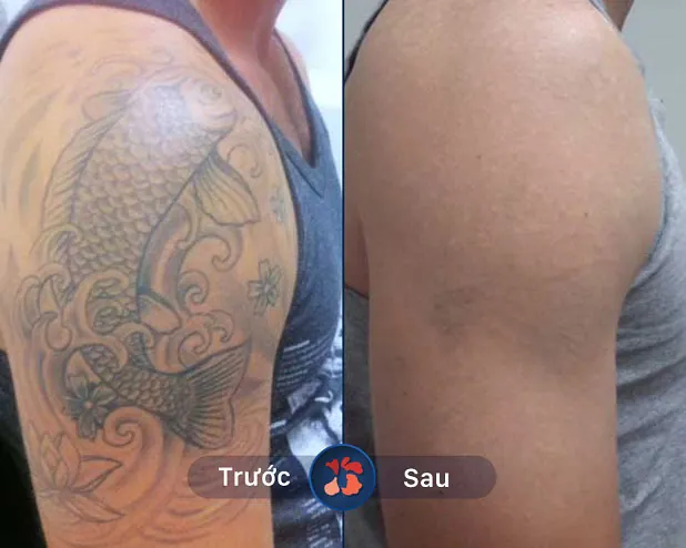 Da mịn màng, không sẹo, sạch mực xăm sau điều trị bằng thế hệ Laser Toning hiện đại
