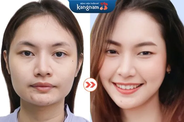 Khách hàng phẫu thuật thu gọn góc hàm V line, có ngay dáng khuôn mặt thon, trẻ trung, duyên dáng