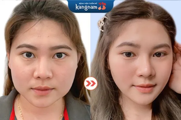 Khách hàng có khuôn mặt dịu dàng hơn sau khi gọt hàm