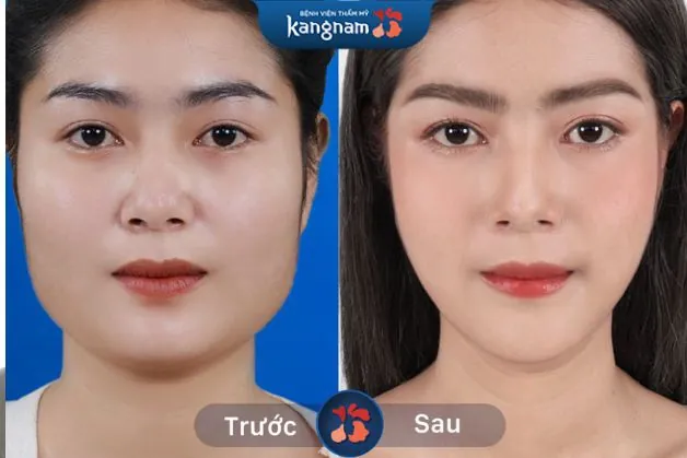 Ca gọt hàm đẹp tự nhiên, đẹp xuất sắc