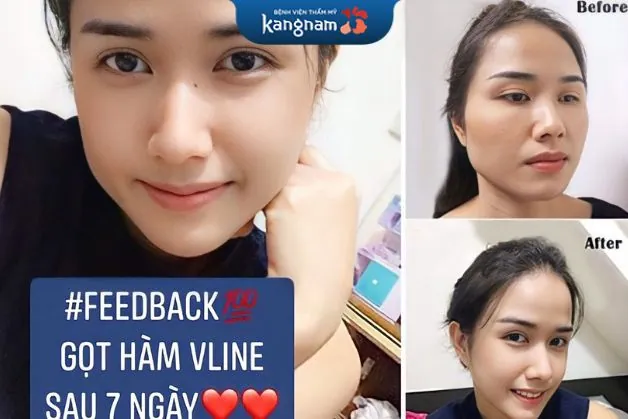 Khách hàng chia sẻ hình ảnh sau 7 ngày gọt hàm tại Kangnam