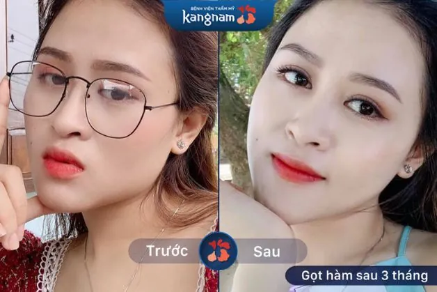 Hình ảnh khách hàng sau 3 tháng thực hiện gọt hàm