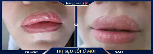 Sẹo tạo nên đường viền môi "gồ ghề", mất cân đôi 2 bên môi đã được là phẳng, cải thiện đến 90%