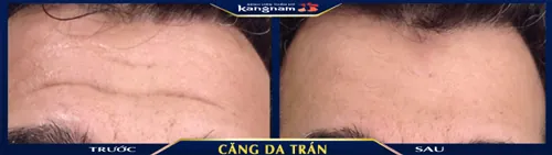 căng da trán nội soi