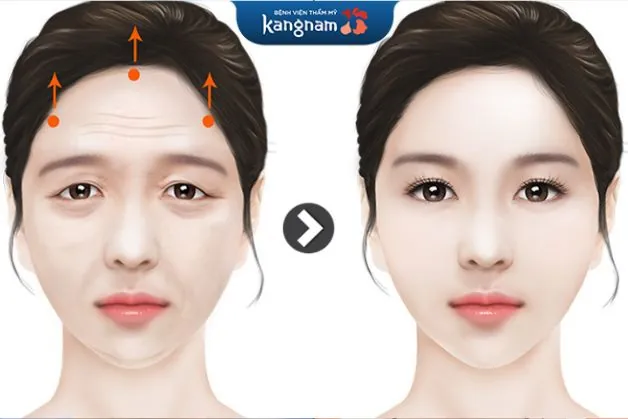 Căng da trán bằng chỉ giúp tạo nên khung đỡ chắc chắn để làm phẳng toàn bộ vùng da chảy xệ, chùng nhão