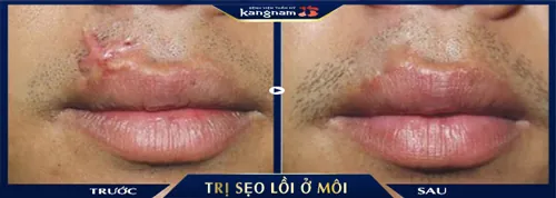 Xóa bỏ hoàn toàn vết sẹo thứ phát ở môi, trả về vẻ thẩm mỹ, sự tự tin cho khách hàng