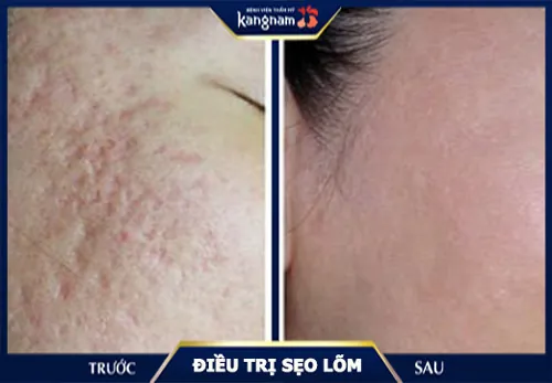 trị sẹo rỗ ở đâu tốt