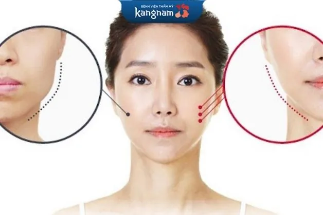 Gọt mặt có biến chứng không?