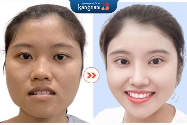 Hình ảnh kết quả trước và sau khi thực hiện Thu gọn góc hàm V line 3D