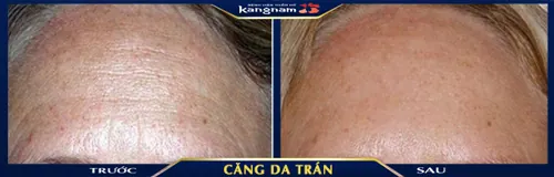 làm căng da trán