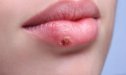 Môi có vết thương hở, mụn rộp là nguyên nhân chính hình thành sẹo