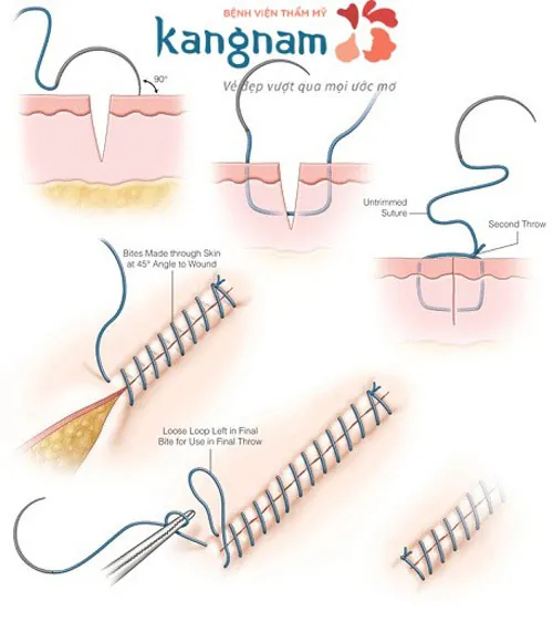 Tùy từng trường hợp sẹo thực tế, bác sĩ sẽ áp dụng kĩ thuật khâu khác nhau để đảm bảo kết quả thẩm mỹ cao nhất