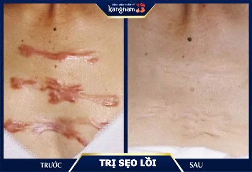 là sẹo lồi ở đâu