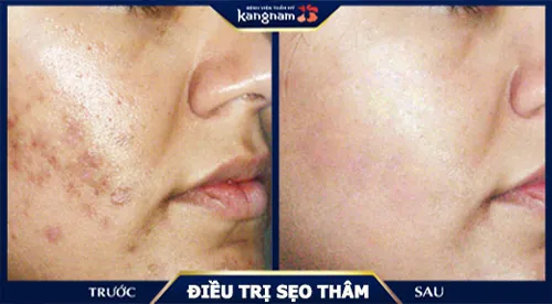 90% sẹo thâm đã được cải thiện triệt để chỉ sau 1 liệu trình điều trị