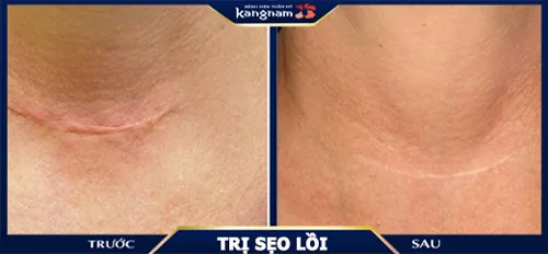 trị sẹo lồi ở đâu