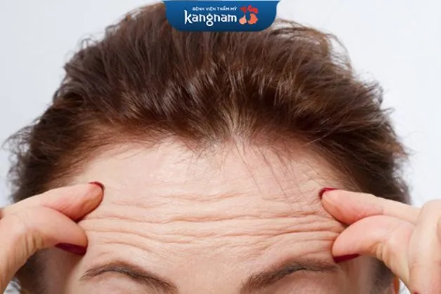 Khách hàng có nhiều vết nhăn trên trán do lão hóa phù hợp để thực hiện trẻ hóa da trán