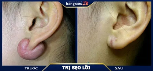 trị sẹo kangnam