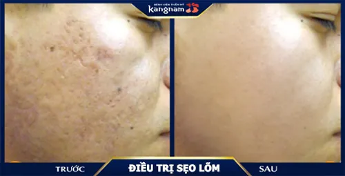 Kết quả thay đổi đáng kinh ngạc của khách hàng sau khi xóa sẹo lõm, rỗ bằng công nghệ Scar Nano
