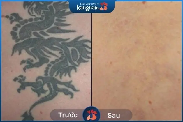 Hình xăm gần như biến mất hoàn toàn – da đều màu sau 4 lần xóa xăm