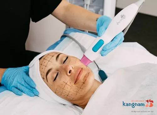 nếp nhăn 2 bên cánh mũi