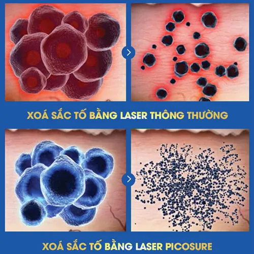 xoá xăm bị nổi mụn nước 