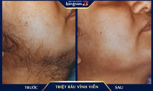 cách triệt râu