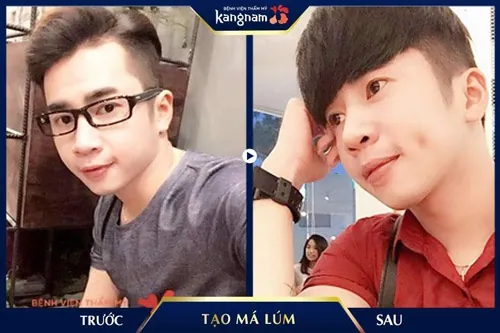 làm má lúm đồng tiền kiêng gì