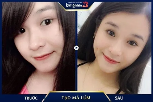 làm má lúm kiêng bao lâu