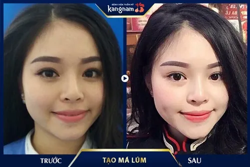 làm má lúm kiêng gì