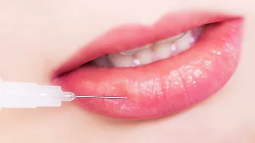Tiêm Botox/Filler là giải pháp xóa nếp nhăn trên môi nhanh chóng, có hiệu quả tức thì