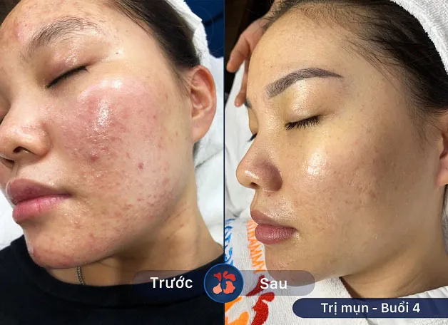 Mụn giảm nhanh sau 4 buổi thực hiện