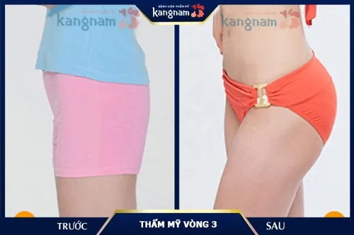 2 bên mông bị hóp