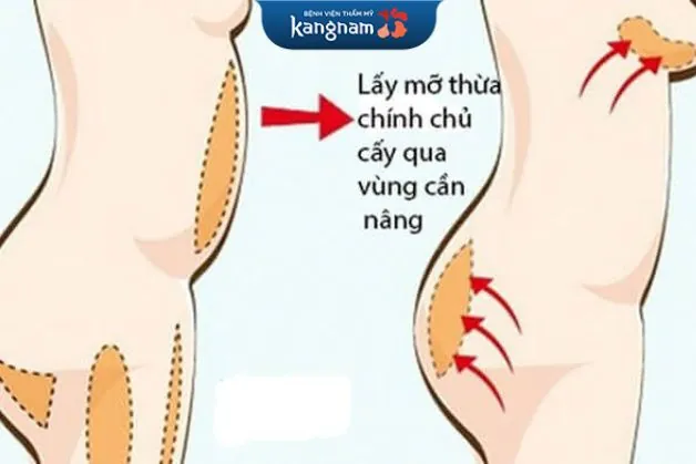 Phương pháp sử dụng chính mỡ tự thân của khách hàng để cấy vào vùng mông thiểu sản lép