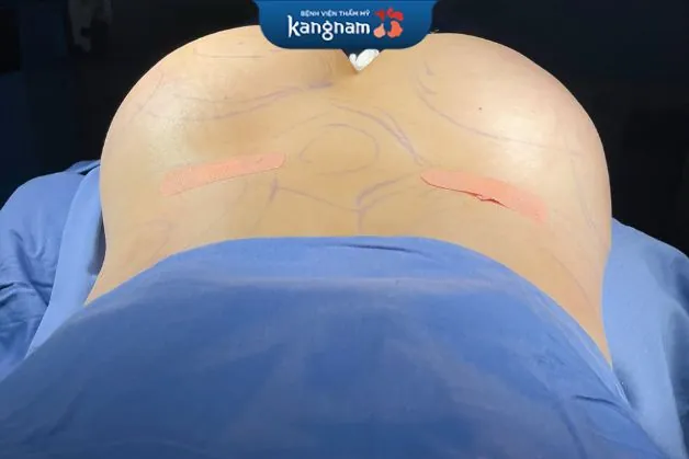 Nâng mông bằng công nghệ tại Kangnam đảm bảo tính hiệu quả