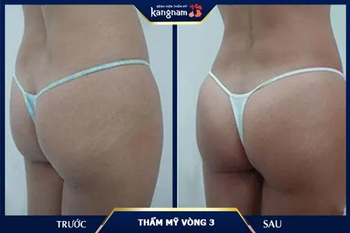 bài tập cho mông bị hóp 2 bên