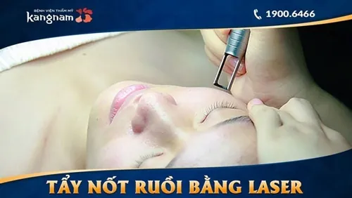 Laser CO2 Fractional mang tới những ưu điểm vượt trội cho khách hàng khi thực hiện xóa nốt ruồi